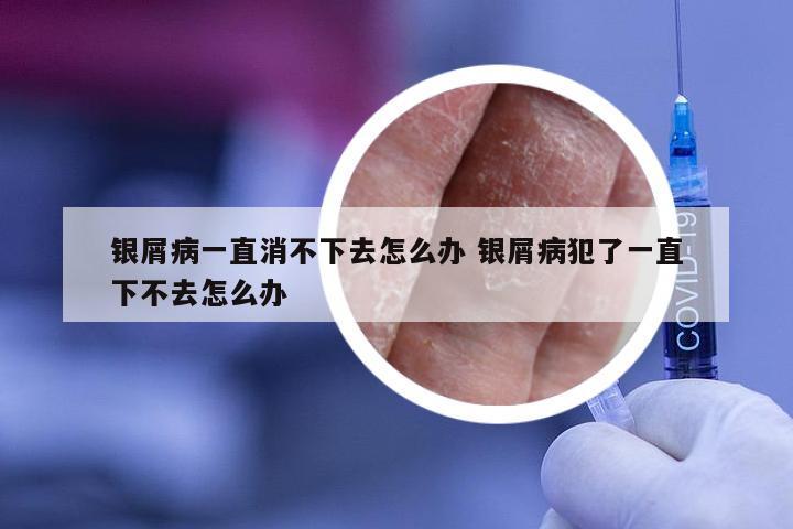 银屑病一直消不下去怎么办 银屑病犯了一直下不去怎么办