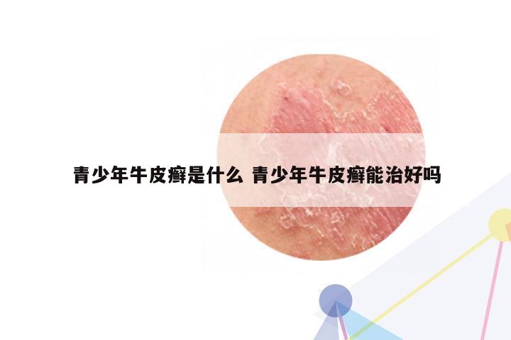 青少年牛皮癣是什么 青少年牛皮癣能治好吗