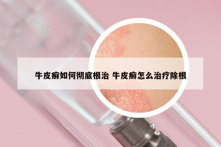 牛皮癣如何彻底根治 牛皮癣怎么治疗除根