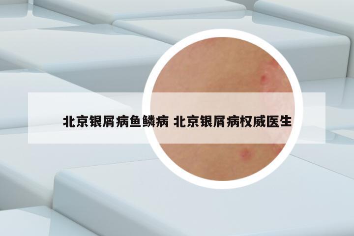 北京银屑病鱼鳞病 北京银屑病权威医生