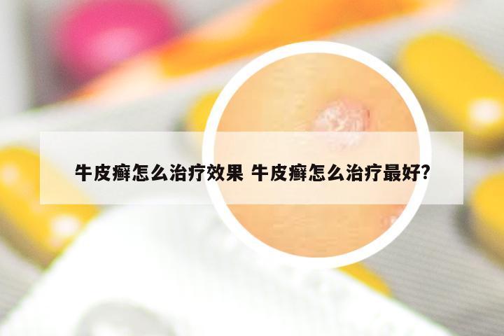 牛皮癣怎么治疗效果 牛皮癣怎么治疗最好?