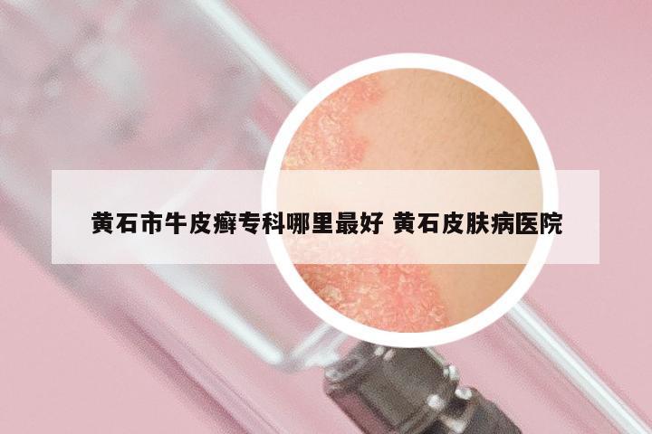 黄石市牛皮癣专科哪里最好 黄石皮肤病医院