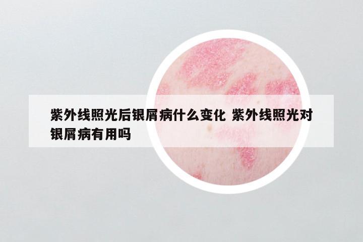 紫外线照光后银屑病什么变化 紫外线照光对银屑病有用吗