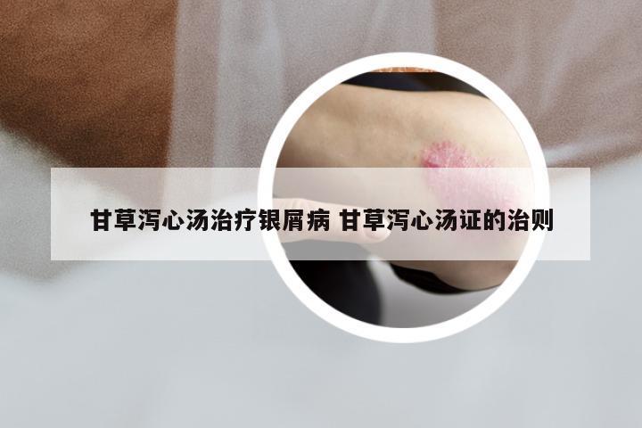 甘草泻心汤治疗银屑病 甘草泻心汤证的治则