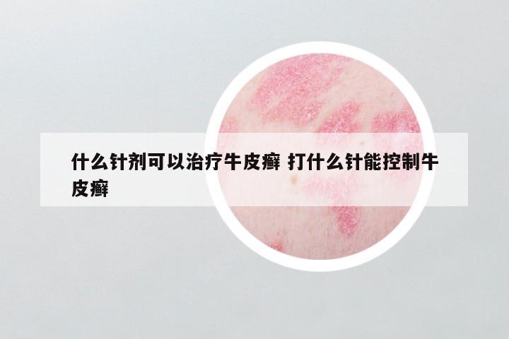 什么针剂可以治疗牛皮癣 打什么针能控制牛皮癣