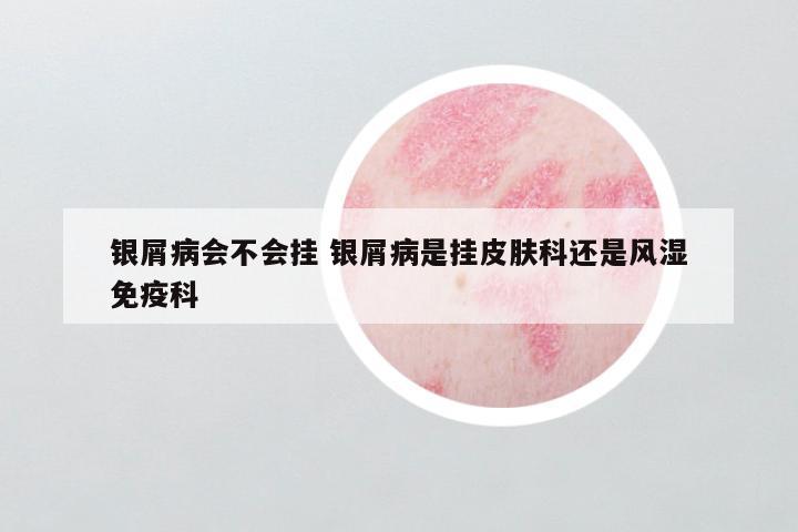 银屑病会不会挂 银屑病是挂皮肤科还是风湿免疫科