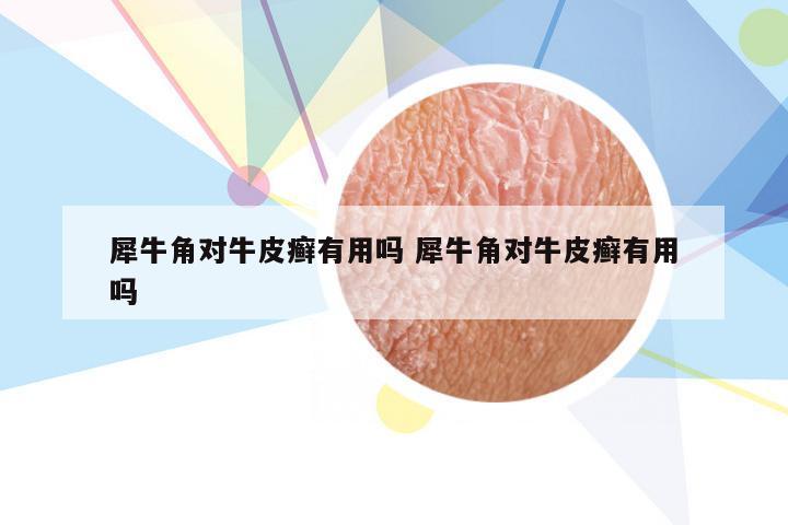 犀牛角对牛皮癣有用吗 犀牛角对牛皮癣有用吗