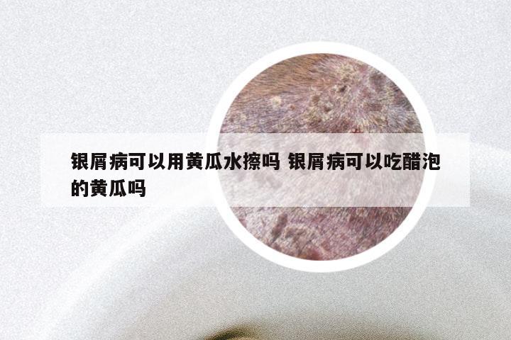银屑病可以用黄瓜水擦吗 银屑病可以吃醋泡的黄瓜吗