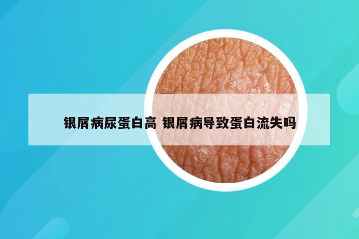 银屑病尿蛋白高 银屑病导致蛋白流失吗