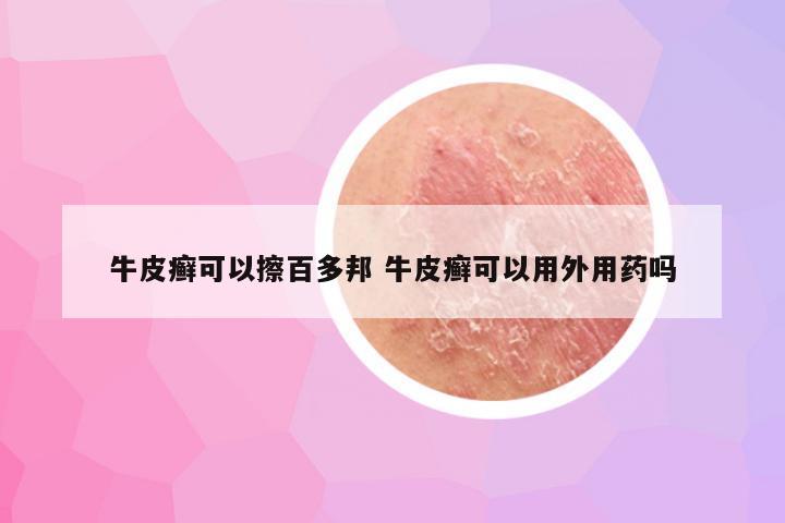 牛皮癣可以擦百多邦 牛皮癣可以用外用药吗