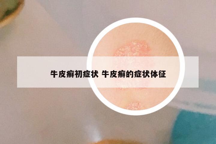 牛皮癣初症状 牛皮癣的症状体征