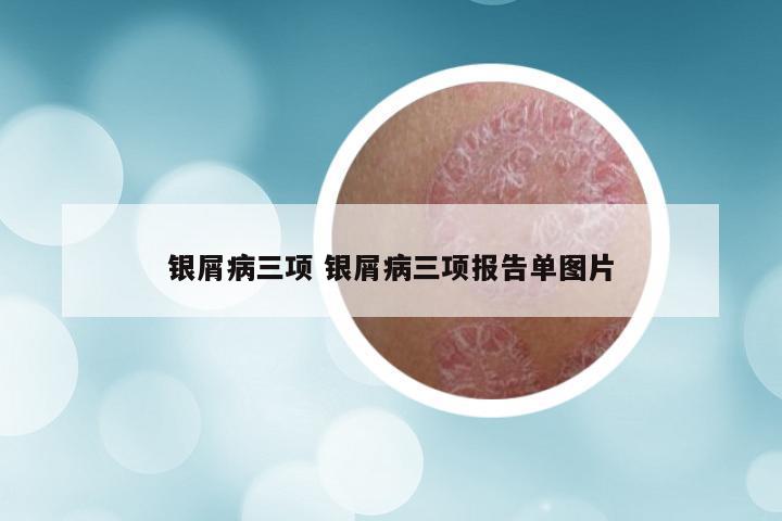 银屑病三项 银屑病三项报告单图片