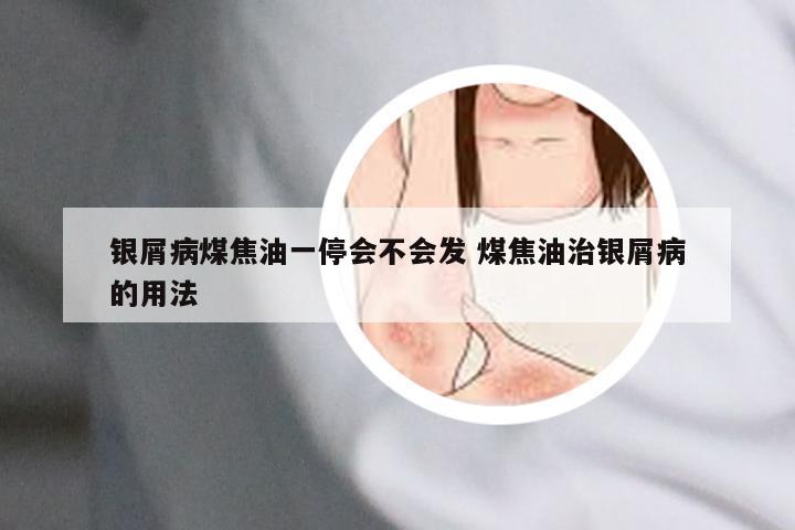 银屑病煤焦油一停会不会发 煤焦油治银屑病的用法