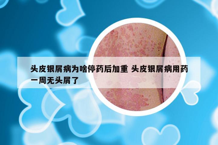 头皮银屑病为啥停药后加重 头皮银屑病用药一周无头屑了