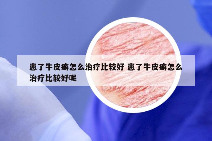 患了牛皮癣怎么治疗比较好 患了牛皮癣怎么治疗比较好呢