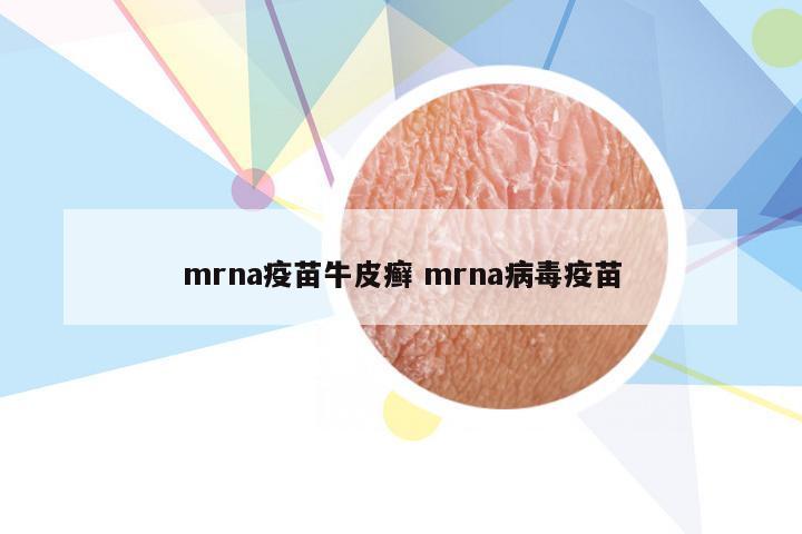 mrna疫苗牛皮癣 mrna病毒疫苗
