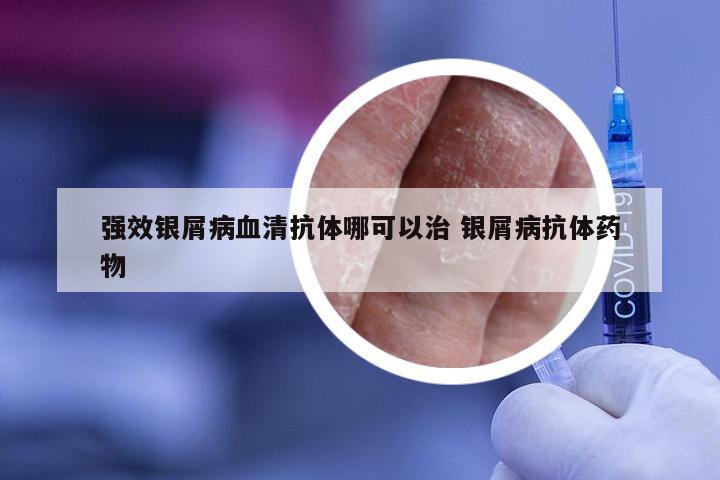 强效银屑病血清抗体哪可以治 银屑病抗体药物