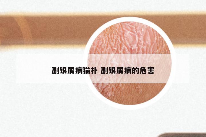 副银屑病猫扑 副银屑病的危害