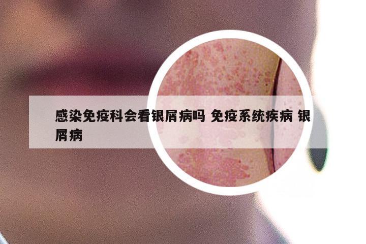 感染免疫科会看银屑病吗 免疫系统疾病 银屑病