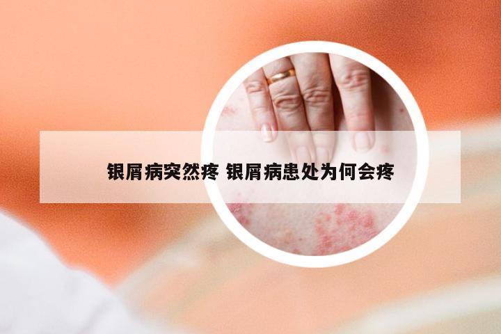 银屑病突然疼 银屑病患处为何会疼