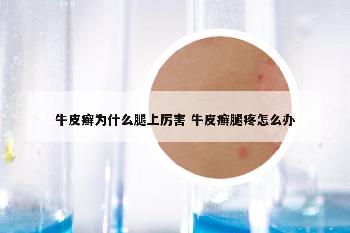 牛皮癣为什么腿上厉害 牛皮癣腿疼怎么办
