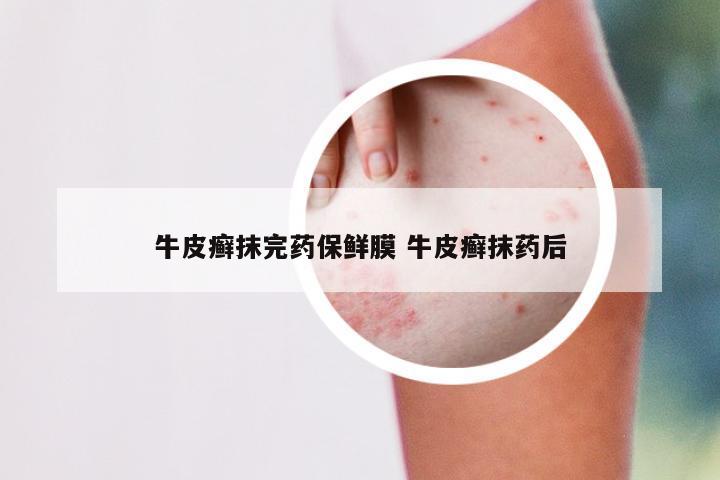 牛皮癣抹完药保鲜膜 牛皮癣抹药后
