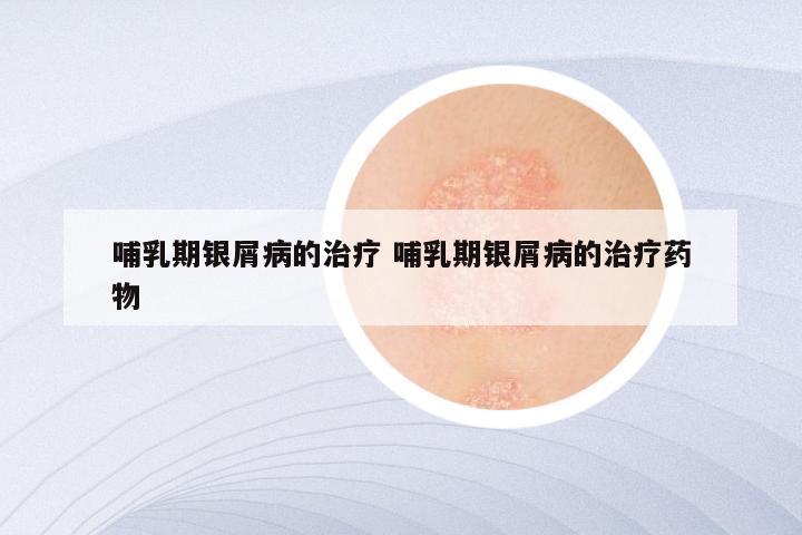 哺乳期银屑病的治疗 哺乳期银屑病的治疗药物