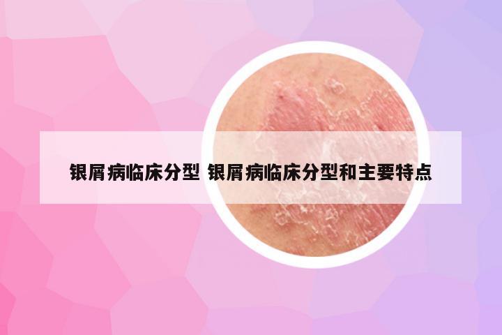 银屑病临床分型 银屑病临床分型和主要特点