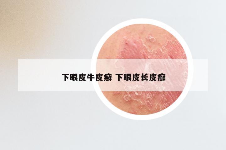 下眼皮牛皮癣 下眼皮长皮癣