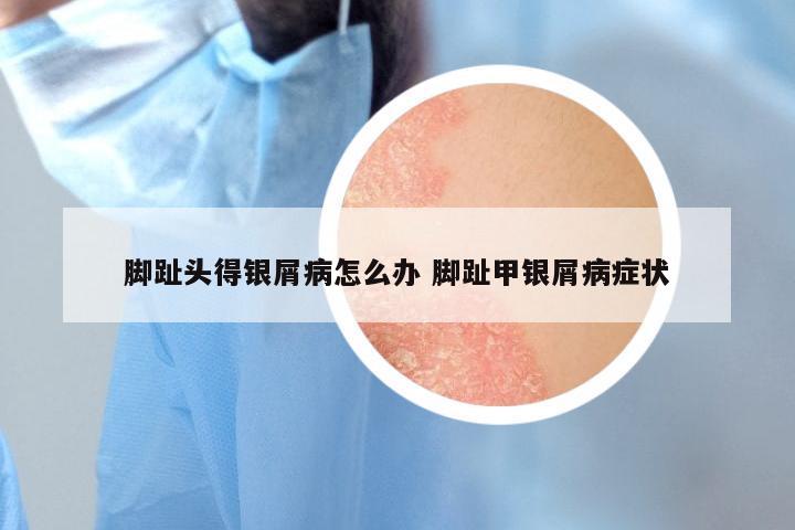 脚趾头得银屑病怎么办 脚趾甲银屑病症状