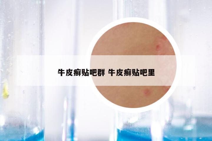 牛皮癣贴吧群 牛皮癣贴吧里