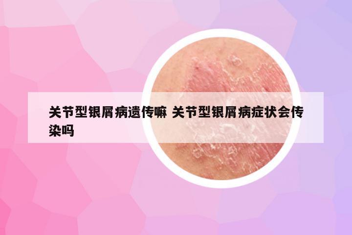 关节型银屑病遗传嘛 关节型银屑病症状会传染吗