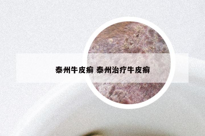 泰州牛皮癣 泰州治疗牛皮癣