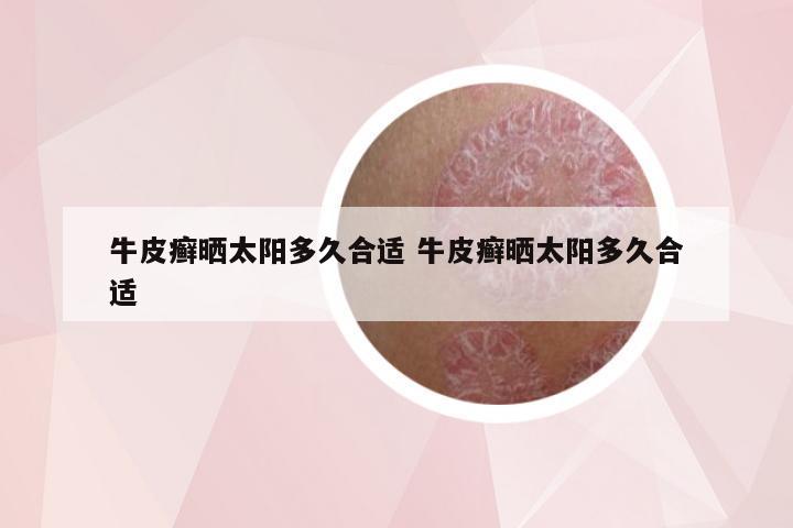 牛皮癣晒太阳多久合适 牛皮癣晒太阳多久合适