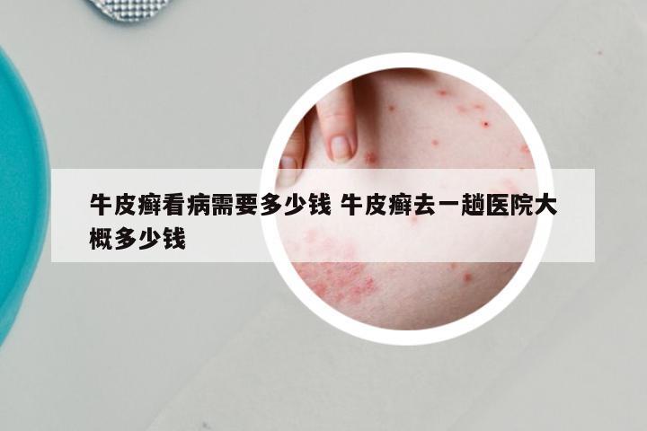 牛皮癣看病需要多少钱 牛皮癣去一趟医院大概多少钱