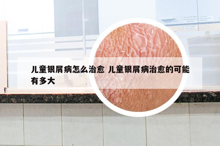 儿童银屑病怎么治愈 儿童银屑病治愈的可能有多大