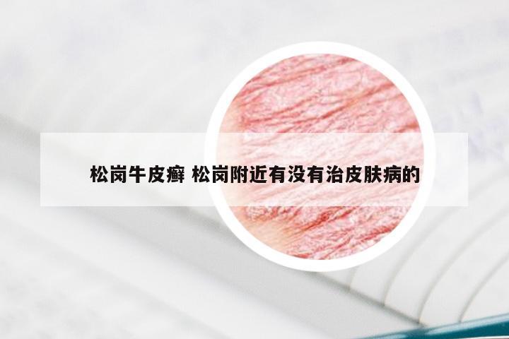 松岗牛皮癣 松岗附近有没有治皮肤病的
