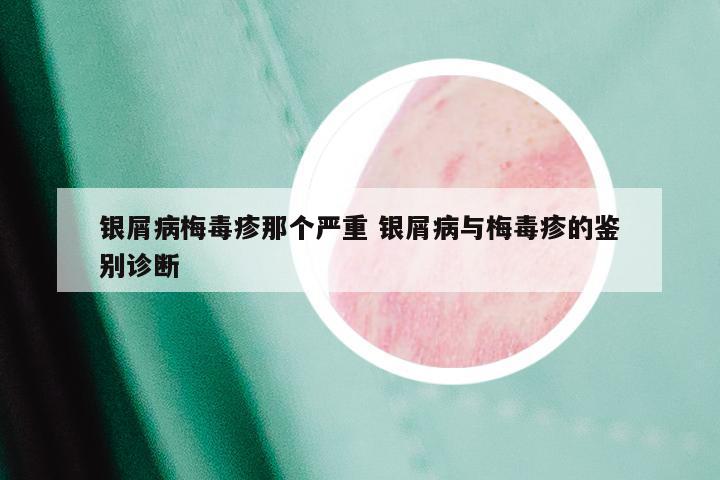 银屑病梅毒疹那个严重 银屑病与梅毒疹的鉴别诊断