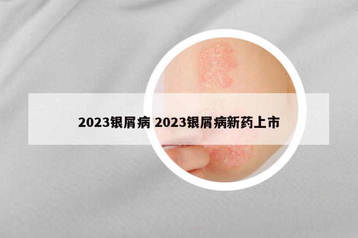 2023银屑病 2023银屑病新药上市