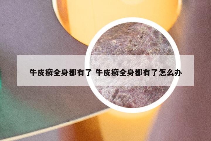 牛皮癣全身都有了 牛皮癣全身都有了怎么办