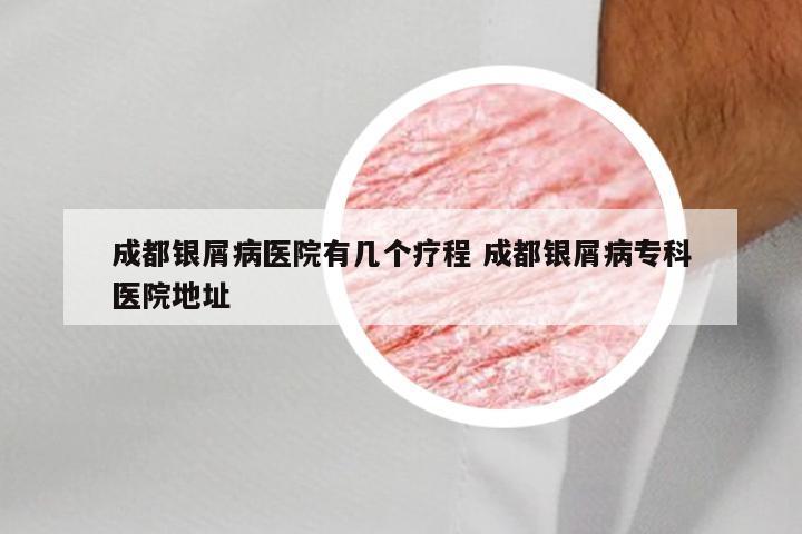 成都银屑病医院有几个疗程 成都银屑病专科医院地址