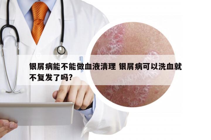 银屑病能不能做血液清理 银屑病可以洗血就不复发了吗?