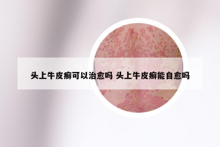 头上牛皮癣可以治愈吗 头上牛皮癣能自愈吗