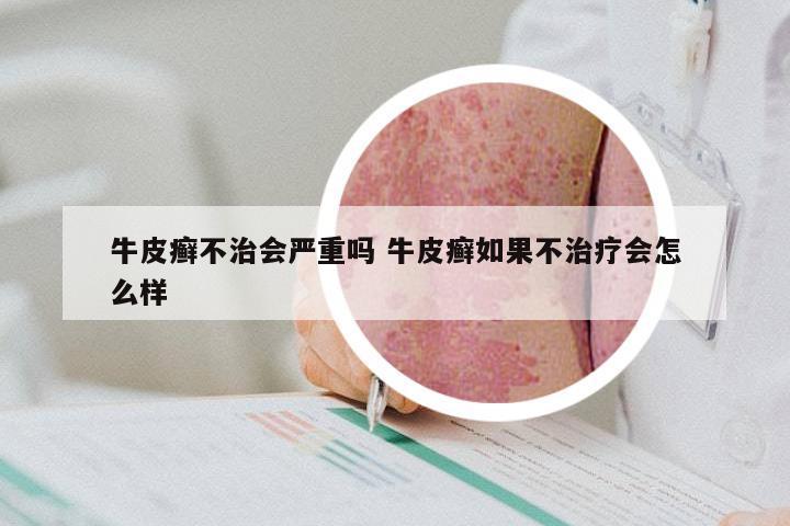 牛皮癣不治会严重吗 牛皮癣如果不治疗会怎么样