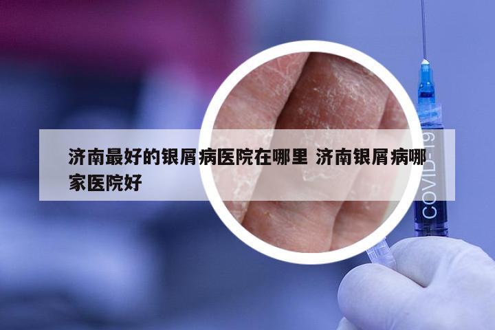 济南最好的银屑病医院在哪里 济南银屑病哪家医院好