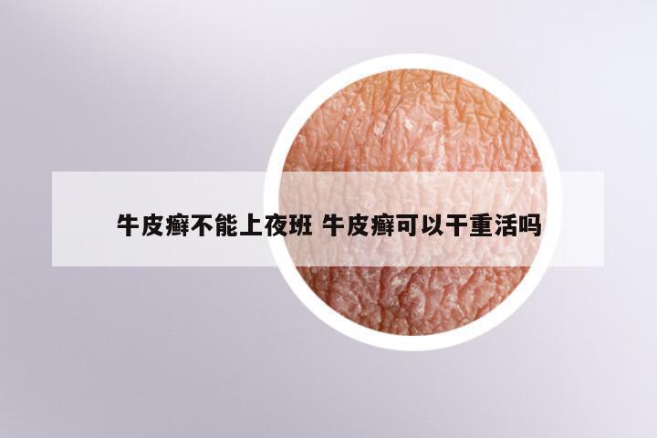 牛皮癣不能上夜班 牛皮癣可以干重活吗