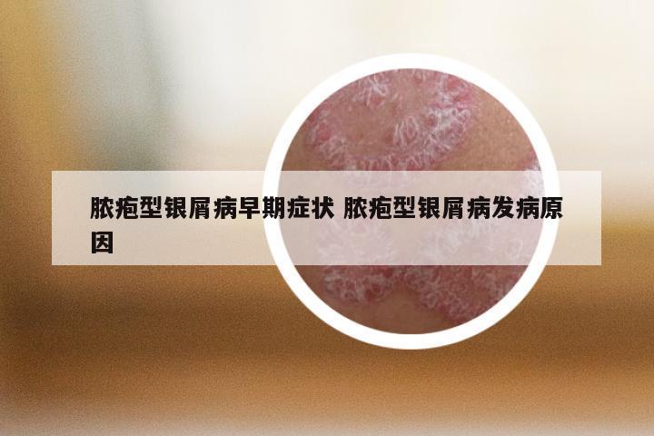 脓疱型银屑病早期症状 脓疱型银屑病发病原因