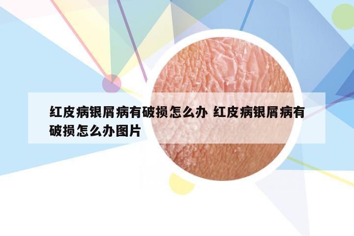 红皮病银屑病有破损怎么办 红皮病银屑病有破损怎么办图片