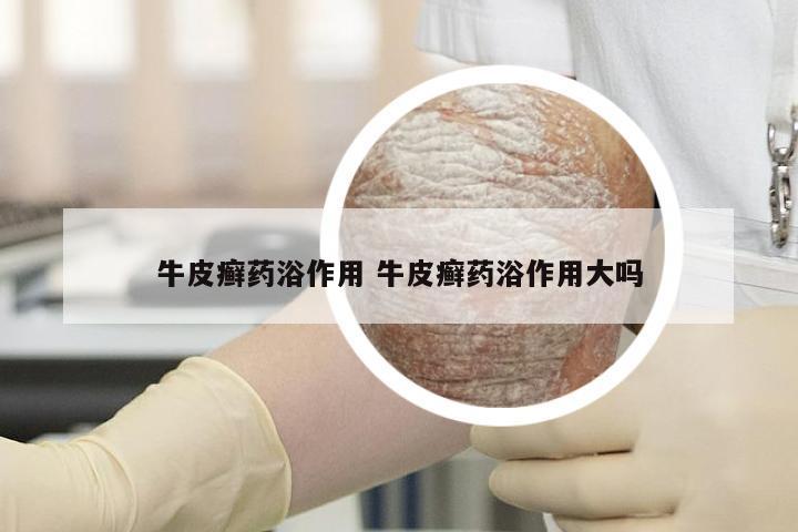 牛皮癣药浴作用 牛皮癣药浴作用大吗
