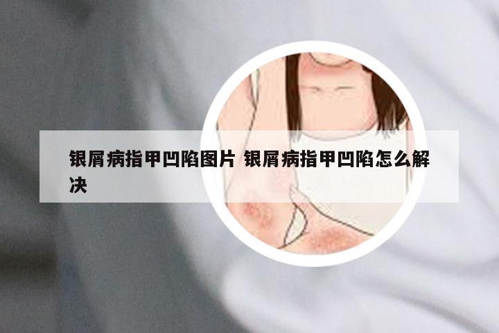 银屑病指甲凹陷图片 银屑病指甲凹陷怎么解决